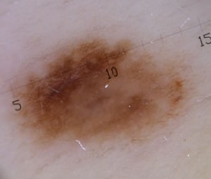 Dermatologo Torino - Dermatoscopia in epiluminescenza - nevo foto dermatoscopia