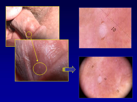 papilloma virus e macchie sulla pelle