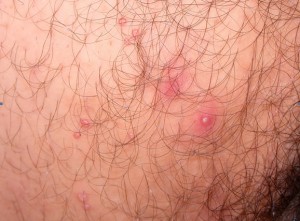 Dermatologo Torino - Malattie sessualmente trasmissibili - Infezione da Mollusco Contagioso Dermatologo Torino - Malattie sessualmente trasmissibili - Infezione da Mollusco Contagioso
