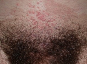 Dermatologo Torino - Malattie sessualmente trasmissibili - Infezione da Mollusco Contagioso Dermatologo Torino - Malattie sessualmente trasmissibili - Infezione da Mollusco Contagioso