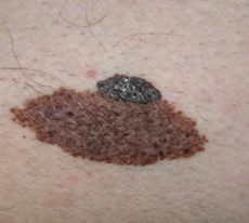 Melanoma cutaneo