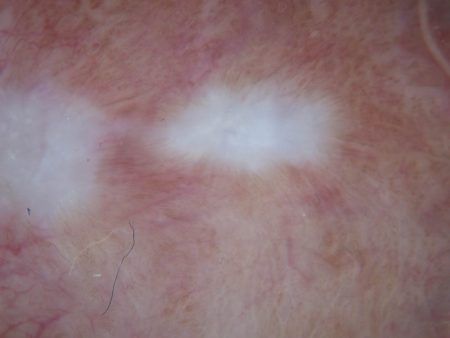 Dermatoscopia di lichen sclerosus (particolare)